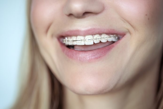 Girl with braces smiling