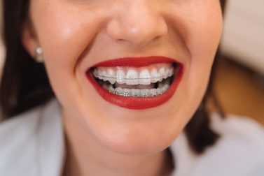 Woman with red lipstick smiling with braces
