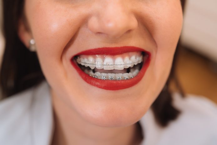 Woman with red lipstick smiling with braces