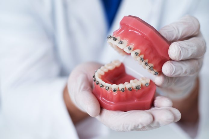 Orthodonticst holding a model mouth display with braces