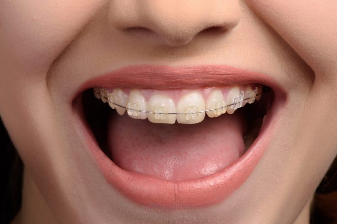 Female smiling with clear metal braces