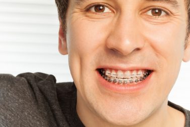 Young man with braces on top and bottom teeth