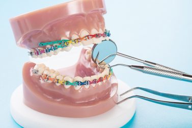 Model mouth display with colorful braces and dental tools