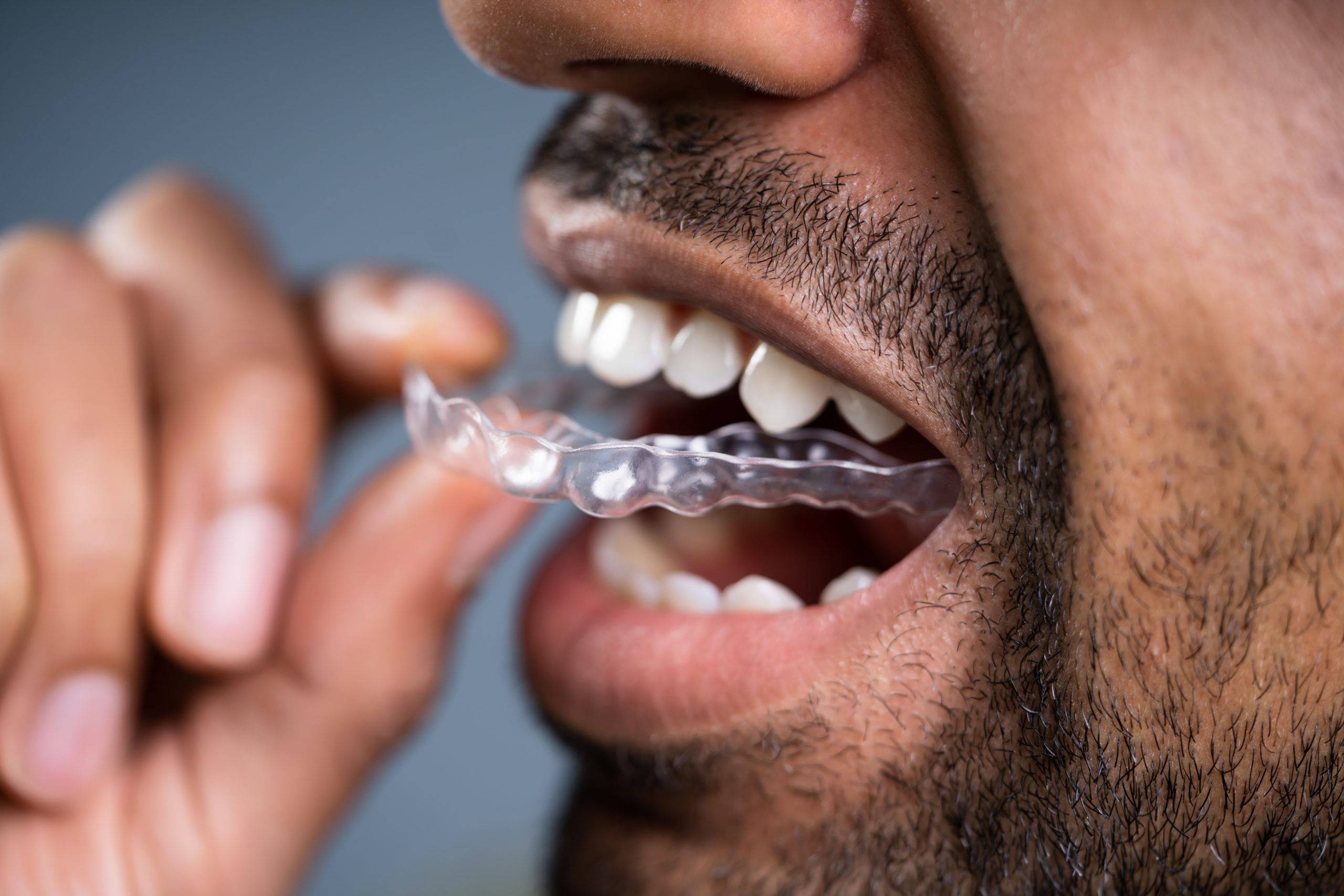 Do You Have To Pay For Retainers After Invisalign