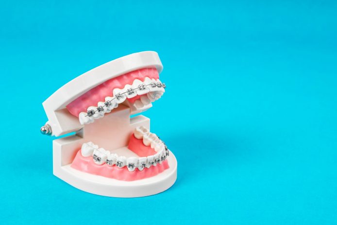 A model mouth display with braces