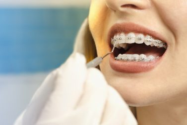 Close up of woman getting braces checked